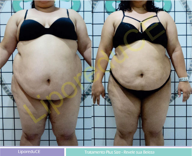 Bem Fisio - Centro de Estética - Obesidade vs Plus size. Muitas